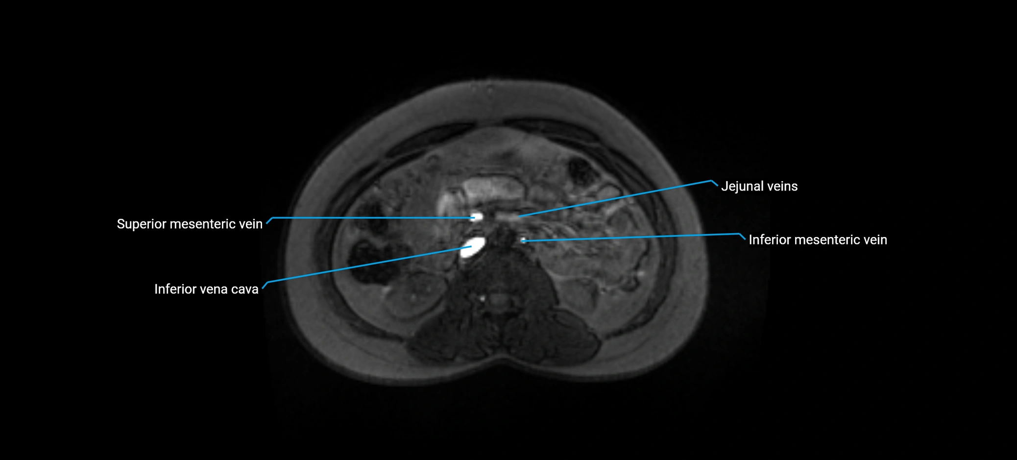 MRV abdomen pelvis & lower limb axial cross sectional anatomy labelled MRI image 81 (1).webp